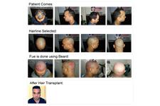 Satyam Hair Transplant Canada image 4