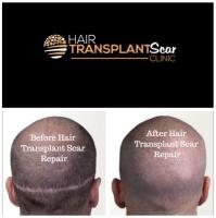 Hair Transplant Scar Clinic image 1