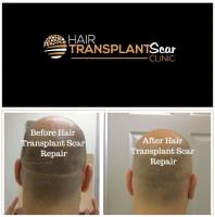 Hair Transplant Scar Clinic image 2