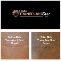 Hair Transplant Scar Clinic image 3