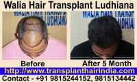 Walia Hair Transplant Ludhiana India image 1