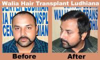 Walia Hair Transplant Ludhiana India image 4