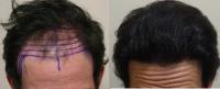 Rahal Hair Transplant Toronto image 25