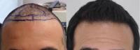 Rahal Hair Transplant Toronto image 34