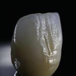 Top All-on-4 implants dental lab - C&P Dental Lab image 5