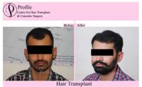 Profile Hair Transplant Centre image 1