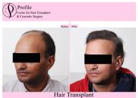 Profile Hair Transplant Centre image 6