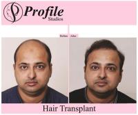 Profile Hair Transplant Centre image 5