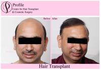 Profile Hair Transplant Centre image 4