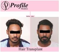 Profile Hair Transplant Centre image 3