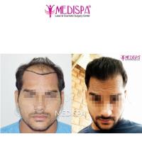 Medispa Hair Transplant Clinic image 3