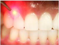 Kamloops Periodontist - Laser Implant Periodontal image 2