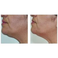 Facial Treatment in Oakville & Toronto image 1