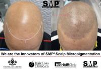 Scalp Micropigmentation image 1