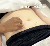 AcuSessions Acupuncture Clinic image 3