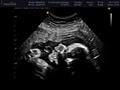 3D Ultrasound  Sono Image image 2