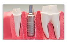 Implants Dentist image 3