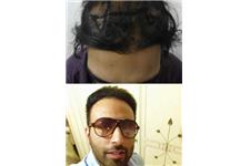Satyam Hair Transplant Canada image 2