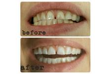 Hsmile Teeth Whitening & Dental Hygiene image 3
