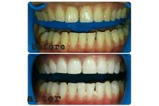 Hsmile Teeth Whitening & Dental Hygiene image 2