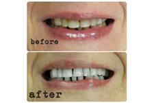 Hsmile Teeth Whitening & Dental Hygiene image 4