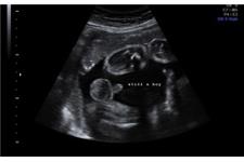 Baby to Be - 4d Ultrasound image 2