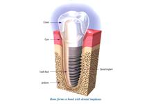 Implants Dentist image 2
