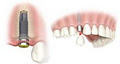 Arista Dentist Guelph - Cosmetic, Whitening, Invisalign, Emergency image 6