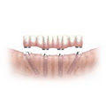 Bardgett Denture & Implant Solutions logo