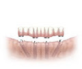 Bardgett Denture & Implant Solutions image 1