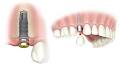 Oshawa Dentist - Cosmetic, Invisalign, Zoom Whitening, Emergency image 6