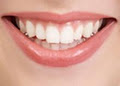 Teeth Whitening Markham image 6