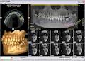 Dr Denzil Nair Wisdom Teeth Extraction & Dental Implants Vancouver image 2