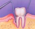 Ottawa Dentist - Invisalign, Zoom Teeth Whitening, Emergency image 5