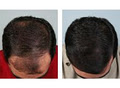 Canadian Hair Transplant Centre image 2