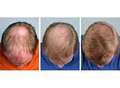 Canadian Hair Transplant Centre image 3