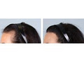 Canadian Hair Transplant Centre image 4
