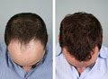 Canadian Hair Transplant Centre image 1