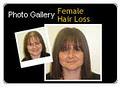 Sure Hair Restoration Mississauga image 6