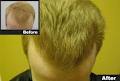 Sure Hair Transplants Kitchener image 5