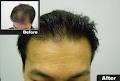 Sure Hair Transplants Kitchener image 6