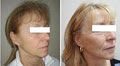 Facial Cosmetic Surgery image 6
