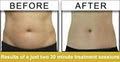 Laserium MedSpa - Laser Hair Removal West Vancouver image 2