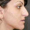 Solomon Rhinoplasty Facial Cosmetic Plastic Surgery Toronto image 3