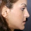 Solomon Rhinoplasty Facial Cosmetic Plastic Surgery Toronto image 4