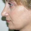 Solomon Rhinoplasty Facial Cosmetic Plastic Surgery Toronto image 6