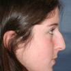 Solomon Rhinoplasty Facial Cosmetic Plastic Surgery Toronto image 1