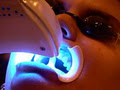 Just Smile - Dental Hygiene and Teeth whitening Services image 3