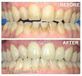 Just Smile - Dental Hygiene and Teeth whitening Services image 4