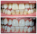 Just Smile - Dental Hygiene and Teeth whitening Services image 5